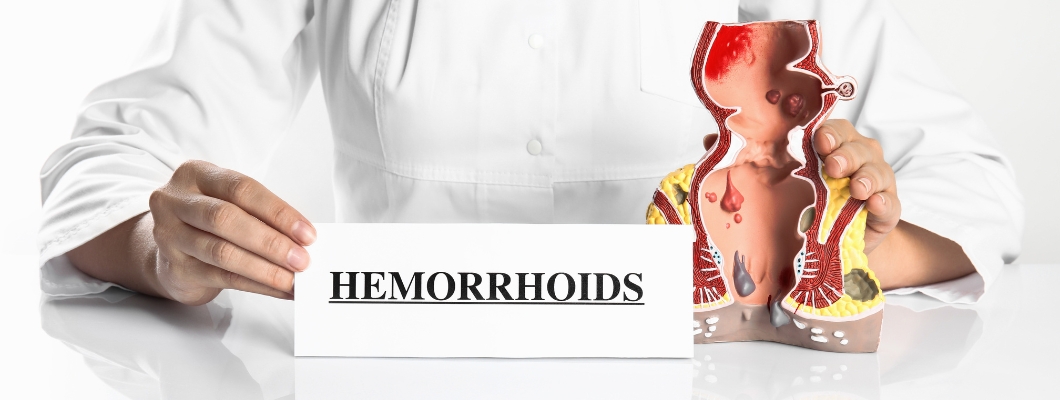 Външни хемороиди - Причини, симптоми и лечение