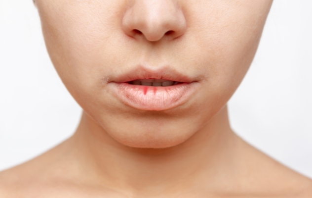 Как да предпазим устните си от напукване
