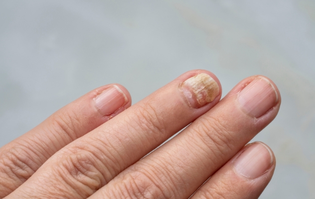 Brittle nails body 2 30.11.2023.jpg